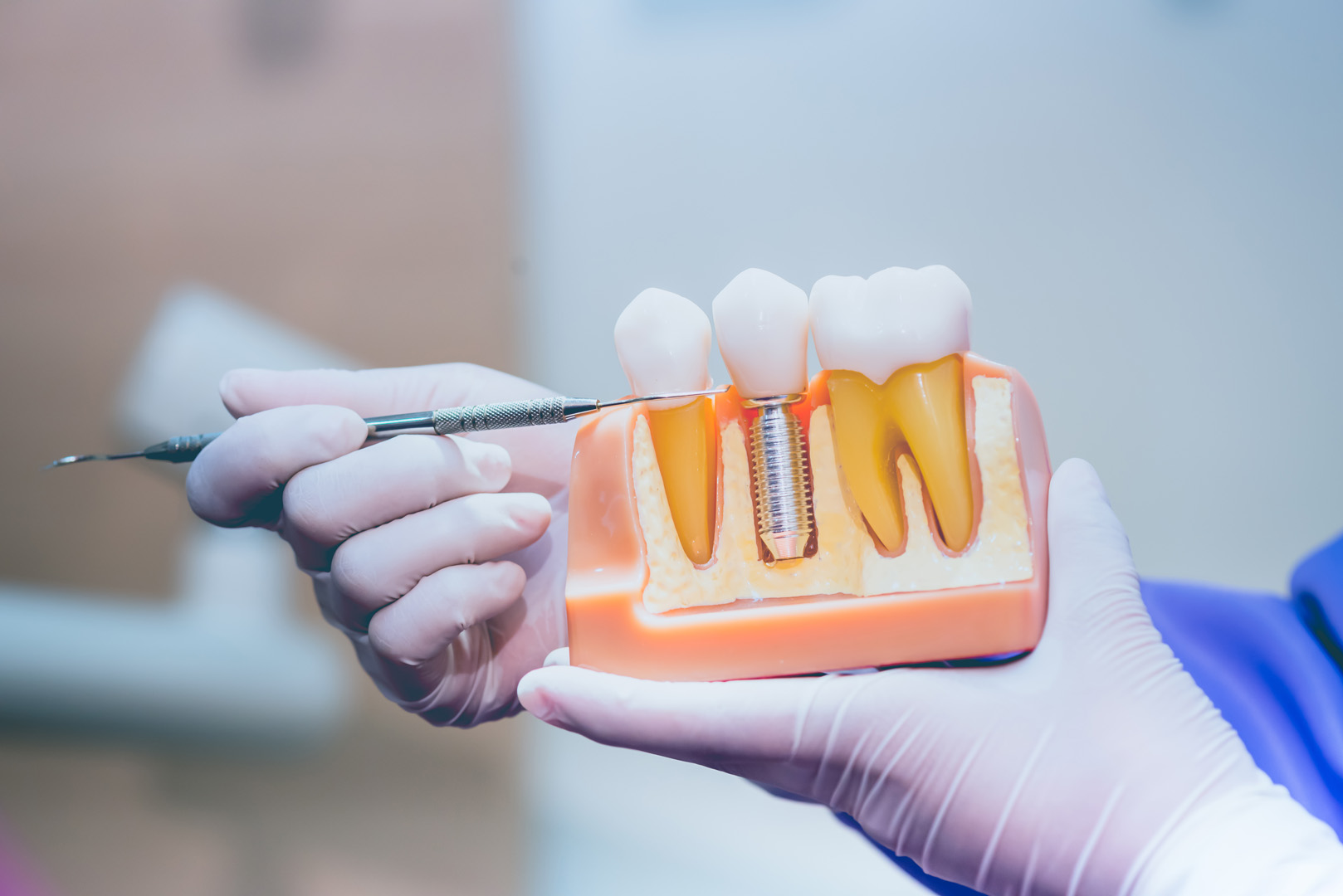 Dental Implants: Necessity, Procedure, Diet
